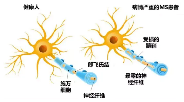 成瘾被定义为一种慢性复发性的脑